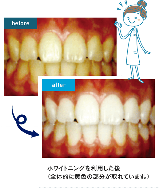 Befor After ホワイトニングを利用し後(全体的に黄色の部分が取れています。)