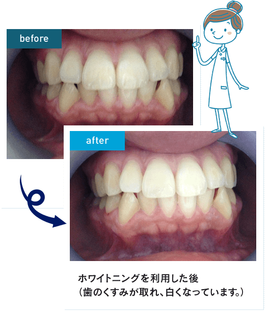 Befor After ホワイトニングを利用し後(歯のくすみが取れ、白くなっています。)